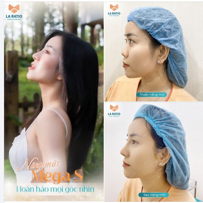 Nâng mũi Mega S - Xử lí hoàn hảo ca mũi có đầu mũi ngắn