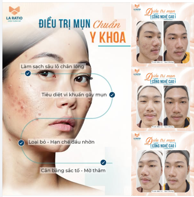 “Em tập gym được 3 tháng thì bắt đầu nổi mụn nhiều, không biết chăm sóc nên mụn ngày càng nặng hơn” - Minh Bảo chia sẻ