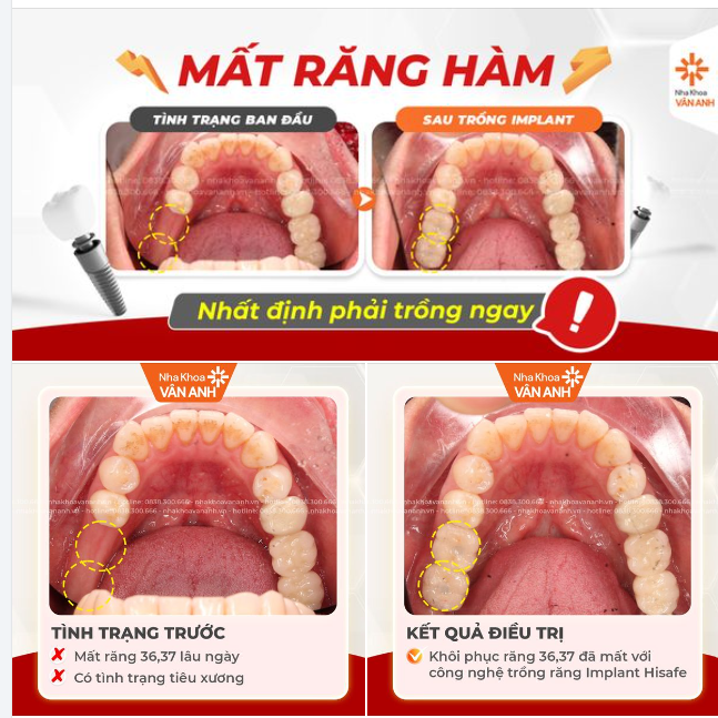TẠI SAO MẤT RĂNG HÀM PHẢI TRỒNG LẠI NGAY