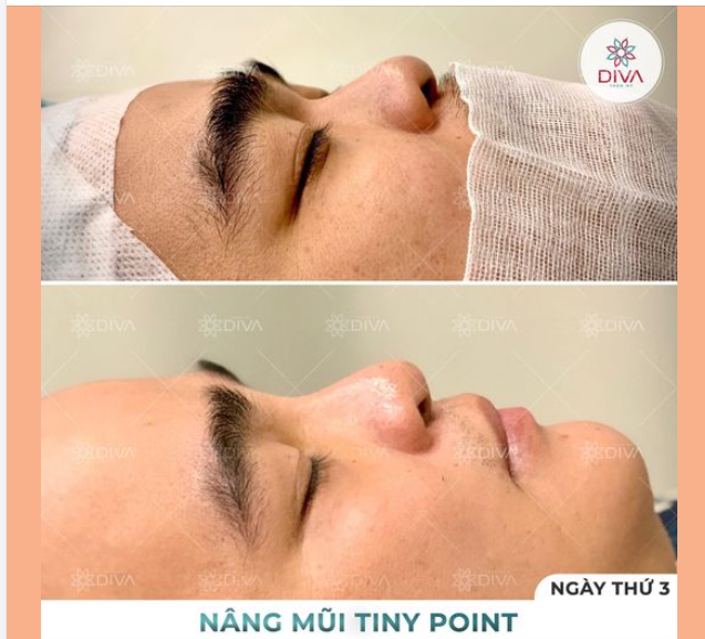 MŨI GÃY SÂU NGANG MẮT: PHƯƠNG PHÁP NÀO CẢI THIỆN TỐT NHẤT?