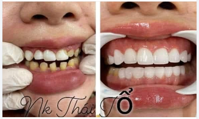 BỌC RĂNG SỨ - GIẢI PHÁP TỐI ƯU CHO RĂNG SỨT MẺ, GÃY VỠ