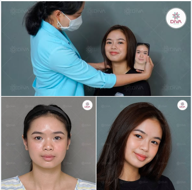 DÁNG MŨI TỰ NHIÊN, NHẸ NHÀNG VÀ HÀI HÒA SAU KHI THỰC HIỆN NÂNG MŨI TINY POINT