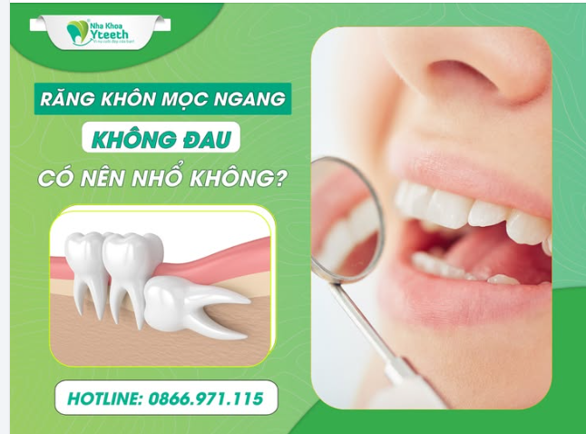 Răng khôn hàm dưới mọc ngang nhưng không gây đau, không sưng có nên nhổ bỏ không?