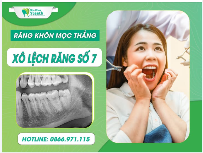 Răng khôn mọc thẳng, làm xô lệch răng số 7