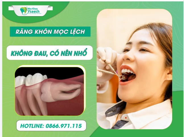 Răng khôn mọc lệch, không đau, có nên nhổ không?