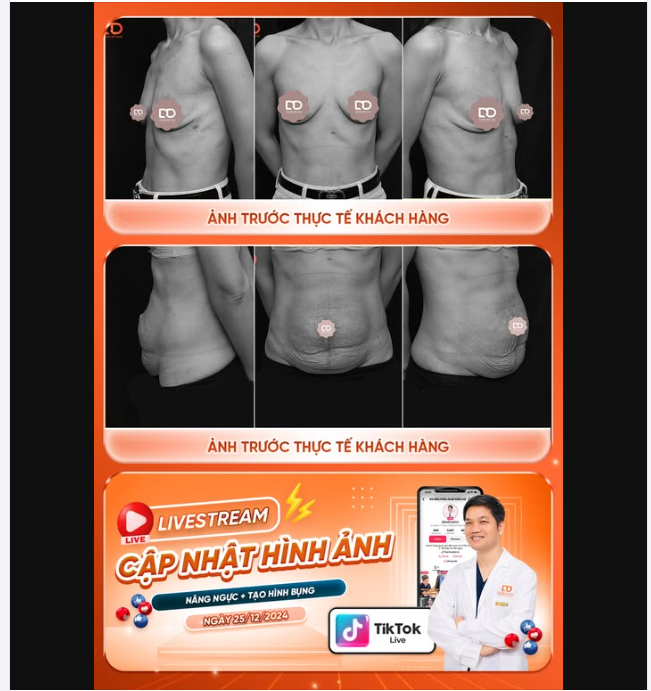 PHẪU THUẬT ĐẶT TÚI ĐỘN + TREO SA TRỄ + TẠO HÌNH BỤNG CHO CHỊ KHÁCH HÀNG ĐẾN TỪ BẮC NINH....