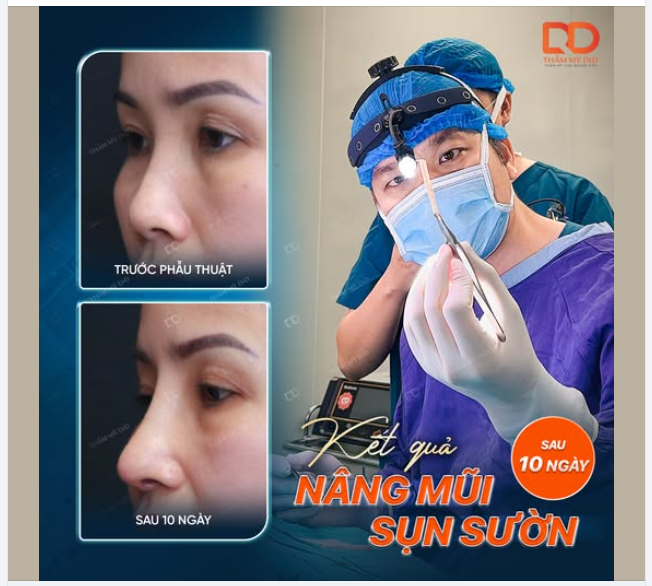 NÂNG MŨI CẤU TRÚC SỤN SƯỜN CHẤT LIỆU TỐT NHẤT KHÔNG THỂ BỎ QUA
