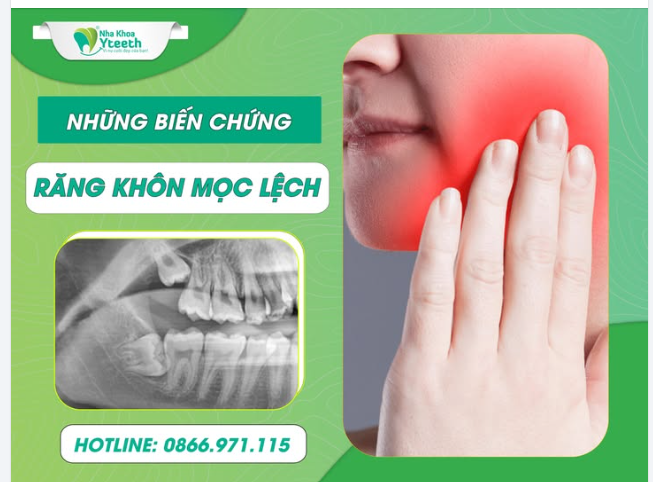 Răng khôn mọc lệch tiềm ẩn những nguy cơ: