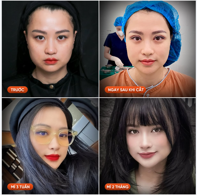 CẮT MÍ ELITE EYES - ĐẸP SẮC NÉT ĐẾN TỪNG MILIMET