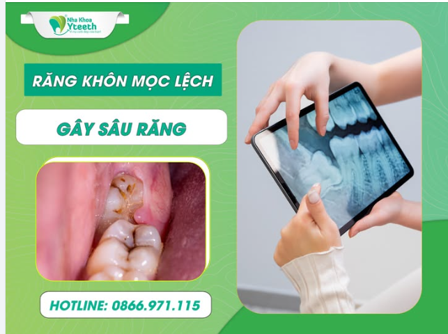 Răng khôn mọc lệch dẫn đến dễ bị dắt thức ăn, cùng với việc nằm sâu phía trong nên việc vệ sinh sạch rất khó nên có nguy cơ sâu răng cao hơn các răng còn lại.