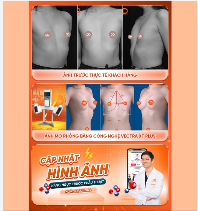 PHẪU THUẬT ĐẶT TÚI ĐỘN CHO BẠN GÁI TRẺ ĐỘC THÂN 20 TUỔI....