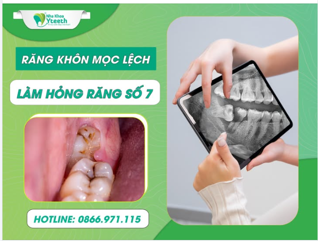 Hỏng răng số 7 do răng khôn mọc lệch