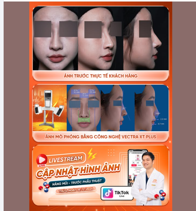 NGAY LÚC NÀY!!!  Ekip Bác sĩ của DrD đang "tái tạo" lại dáng mũi mới cho khách hàng đã từng nâng mũi tại 1 cơ sở khác.