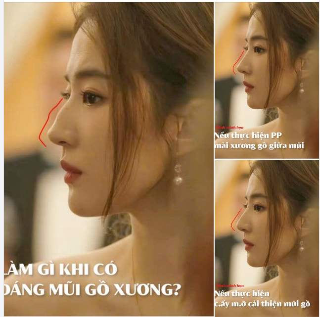 LÀM GÌ KHI CÓ MỘT CHIẾC MŨI GỒ XƯƠNG?