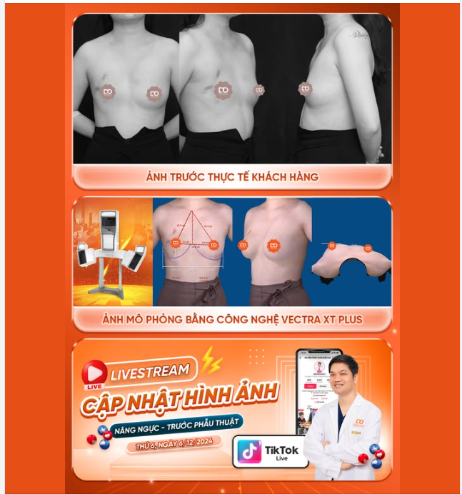 PHẪU THUẬT TÂN TRANG V1 CHO CHỊ KHÁCH HÀNG ĐẾN TỪ PHÚ THỌ....