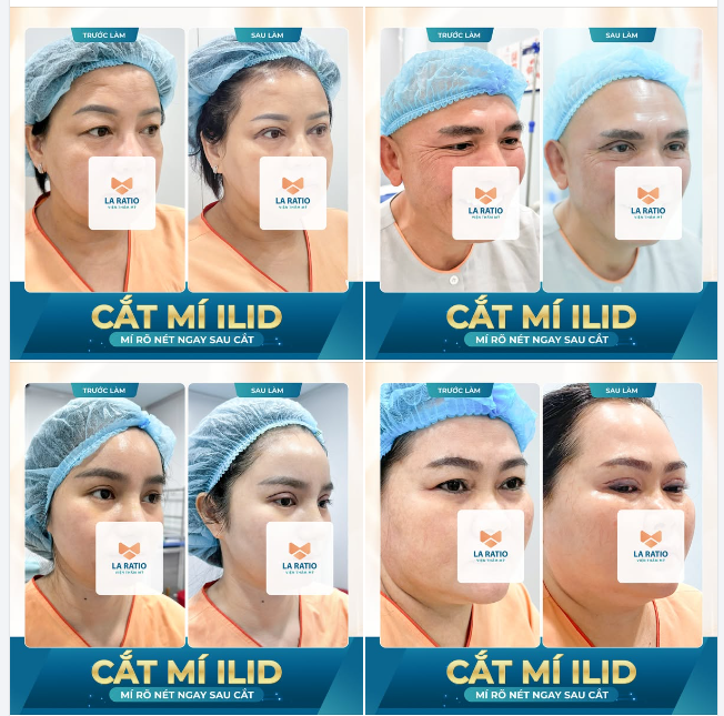 Công nghệ cắt mí ILiD tại La Ratio ​​​​​​​ Không để lại vết tích thẩm mỹ Lành thương nhanh Nếp mí tự nhiên, tròn đều, rõ nét.