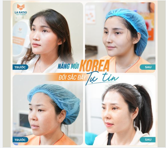 NÂNG MŨI KOREA - ĐỔI SẮC ĐẦY TỰ TIN