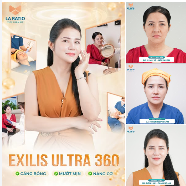 Exilis Ultra 360 Căng bóng - Mướt mịn - Nâng cơ