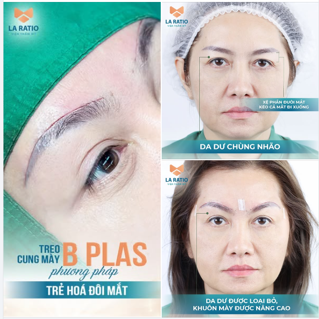 TREO CUNG CHÂN MÀY - PHƯƠNG PHÁP PHẪU THUẬT TRẺ HOÁ MẮT TUYỆT VỜI