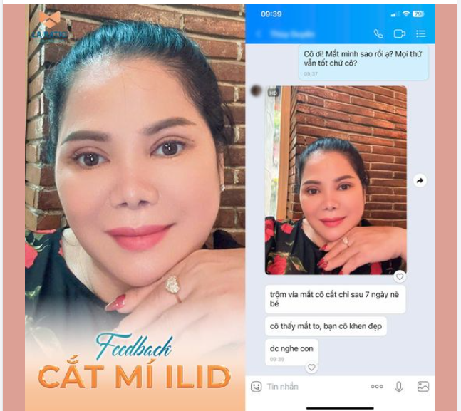 Phản hồi mắt sau 7 ngày cắt chỉ của khách hàng viện thẩm mỹ La Ratio. Nếp mí to rõ, tròn đều 2 bên, loại bỏ hoàn toàn tình trạng da dư chùng nhão trước đó.