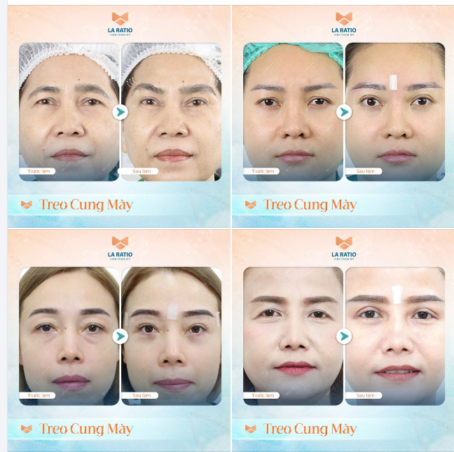 NÂNG CUNG CHÂN MÀY - TRẺ HÓA VÙNG MẮT