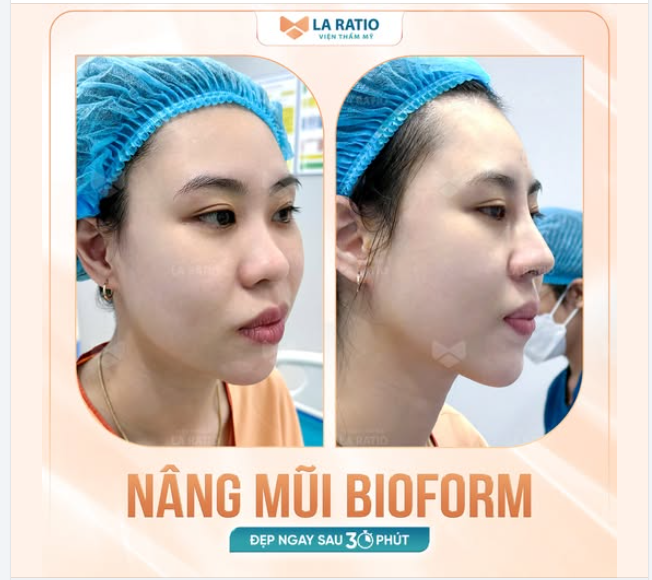 Nâng mũi BIOFORM - Phương pháp hiệu quả cho khách hàng muốn dáng mũi bay