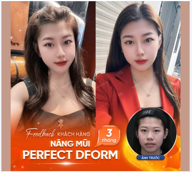 Xinh thế này bảo sao ai cũng chọn Nâng Perfect Dform