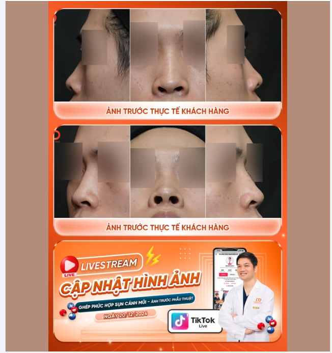 Cánh mũi bị khuyết thiếu hay còn gọi là lỗ mũi hở. Làm thế nào để cải thiện phần cánh mũi giúp cân đối và thẩm mỹ hơn?