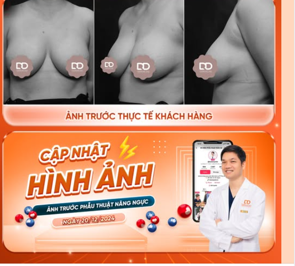 PHẪU THUẬT ĐẶT TÚI ĐỘN + TREO SA TRỄ ĐỘ 3 CHO CHỊ KHÁCH HÀNG ĐẾN TỪ TUYÊN QUANG....