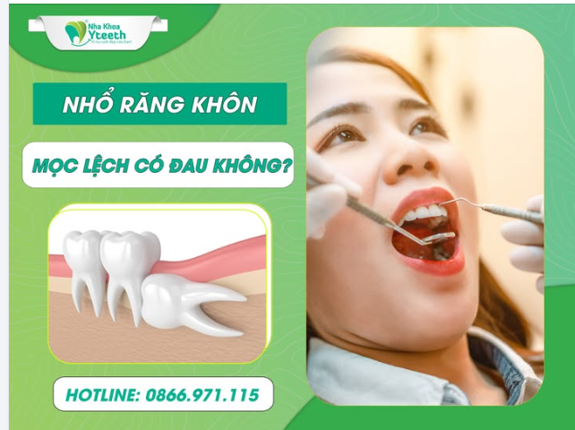 Nhổ răng khôn mọc lệch có đau không?