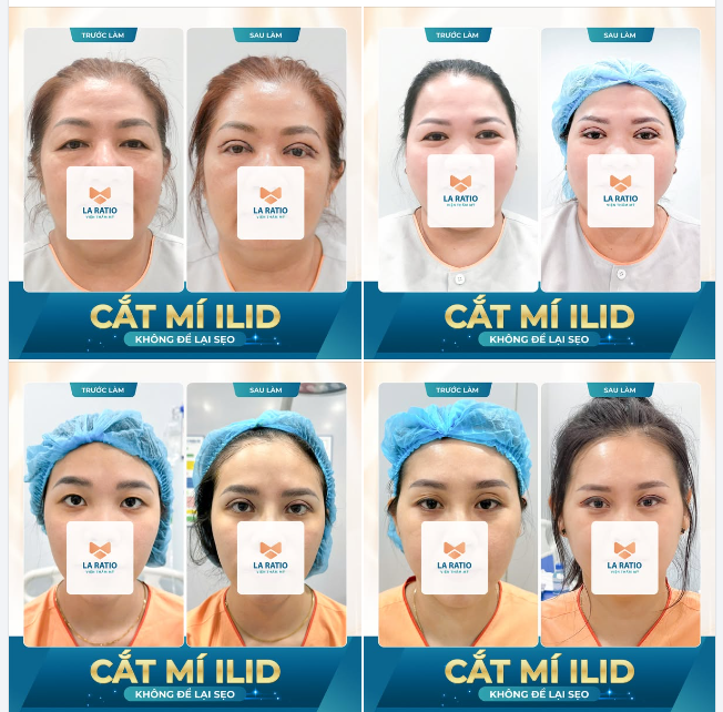 CẮT MÍ ILiD - LỰA CHỌN HÀNG ĐẦU CHO ĐÔI MẮT ĐẸP