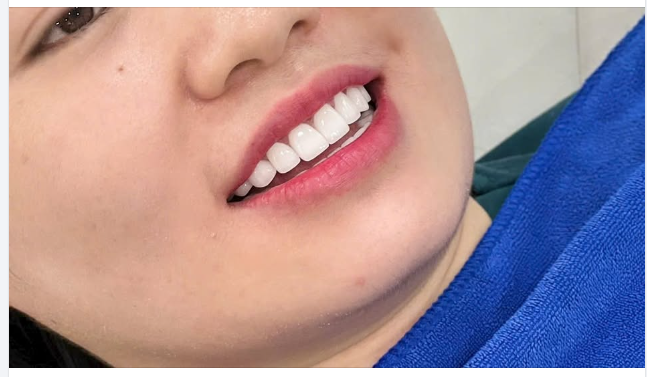 RĂNG SỨ THẨM MỸ - CHÌA KHÓA CHO NỤ CƯỜI TỰ TIN