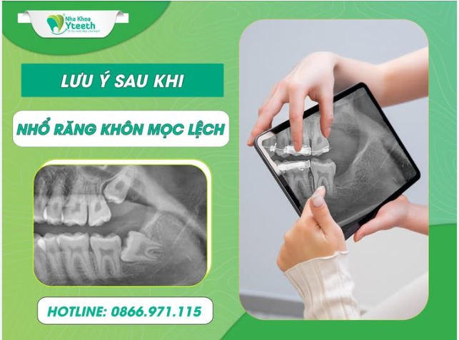 Lưu ý sau khi nhổ răng khôn mọc lệch