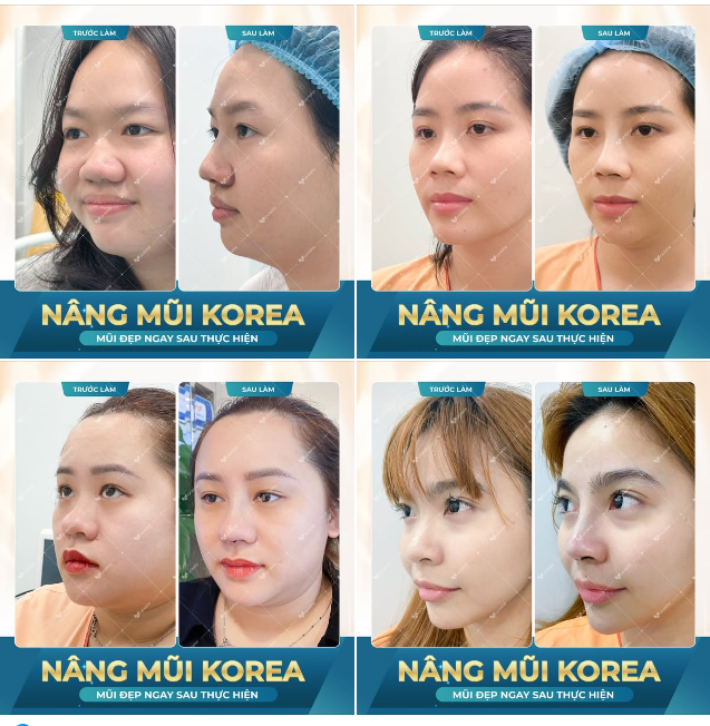 Nâng mũi cấu trúc Korea - Tôn tạo dáng mũi đẹp chuẩn Hàn