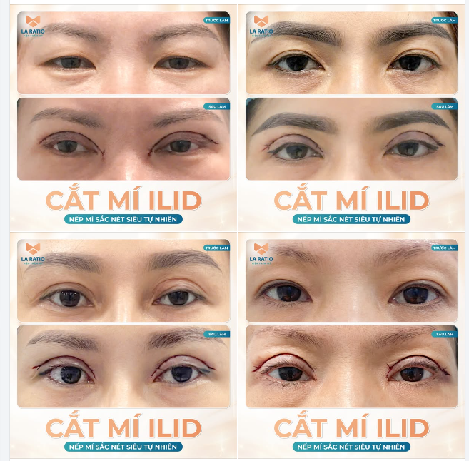 CẮT MÍ ILiD - NẾP MÍ SẮC NÉT SIÊU TỰ NHIÊN