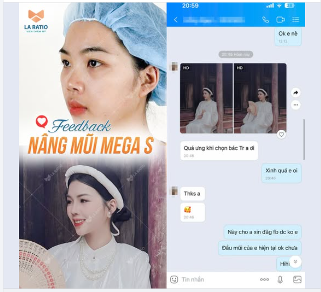 Feedback cực xịn của khách hàng sau 1 năm nâng mũi.