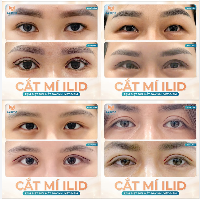 CẮT MÍ ILiD - TẠM BIỆT ĐÔI MẮT ĐẦY KHUYẾT ĐIỂM