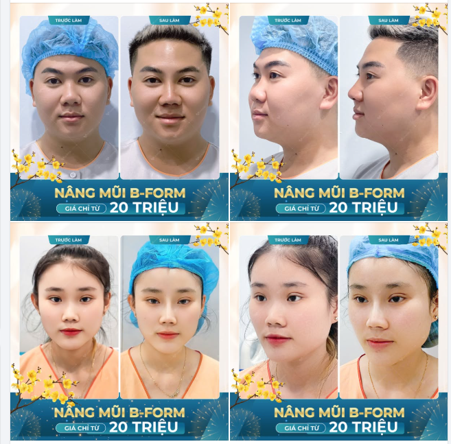 CHÀO NĂM MỚI - VTM LA RATIO BÙNG NỔ ƯU ĐÃI NÂNG MŨI