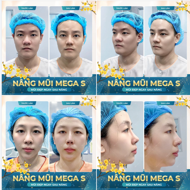 Xu hướng nâng mũi cấu trúc - KHÔNG BĂNG NẸP - La Ratio đánh dấu lối đi riêng trên thị trường.