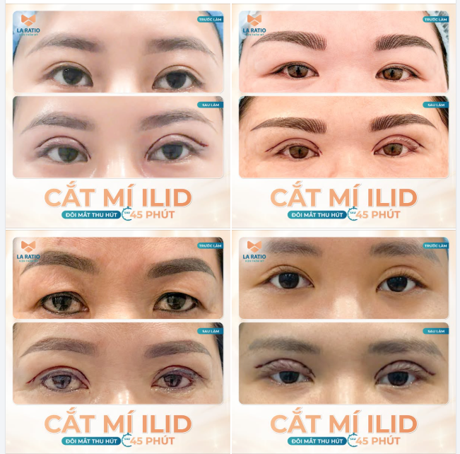 Phục hồi mí lỗi, mí sụp ​​​​​​​ Khắc phục da dư chùng nhão đuôi mắt, mỡ thừa mí mắt Bằng công nghệ cắt mí ILiD tại La Ratio.