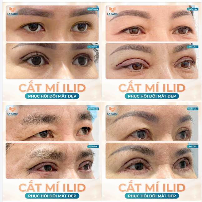 Phục hồi lại đôi mắt của thanh xuân, thay đổi hình dáng đôi mắt 360 độ sau khi sử dụng dịch vụ cắt mí ILiD tại nhà La Ratio