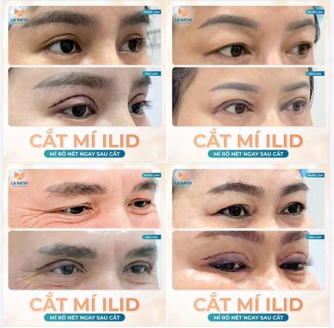Công nghệ cắt mí ILiD tại La Ratio Không để lại vết tích thẩm mỹ Lành thương nhanh ​​​​​​​Nếp mí tự nhiên, tròn đều, rõ nét.