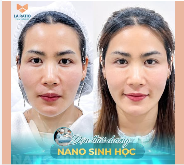 Độn thái dương nano sinh học phương pháp làm đầy thái dương lõm nhanh chóng hiệu quả cho các nàng
