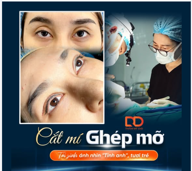 CẮT MÍ GHÉP MỠ - TÁI SINH ÁNH NHÌN TINH ANH, TƯƠI TRẺ