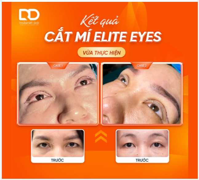 ÁNH NHÌN DỊU DÀNG CHỈ VỚI 1 CAN THIỆP NHẸ NHÀNG