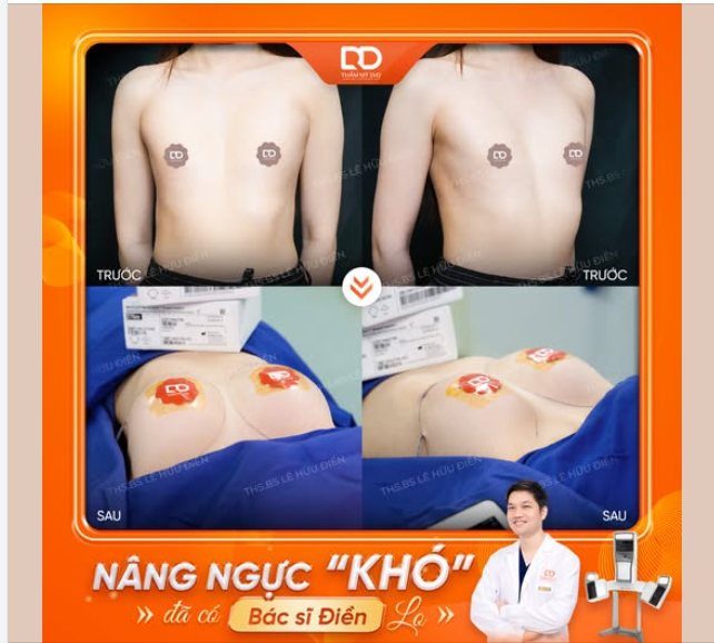 NÂNG NGỰC KHÓ - ĐÃ CÓ BÁC SĨ ĐIỀN LO