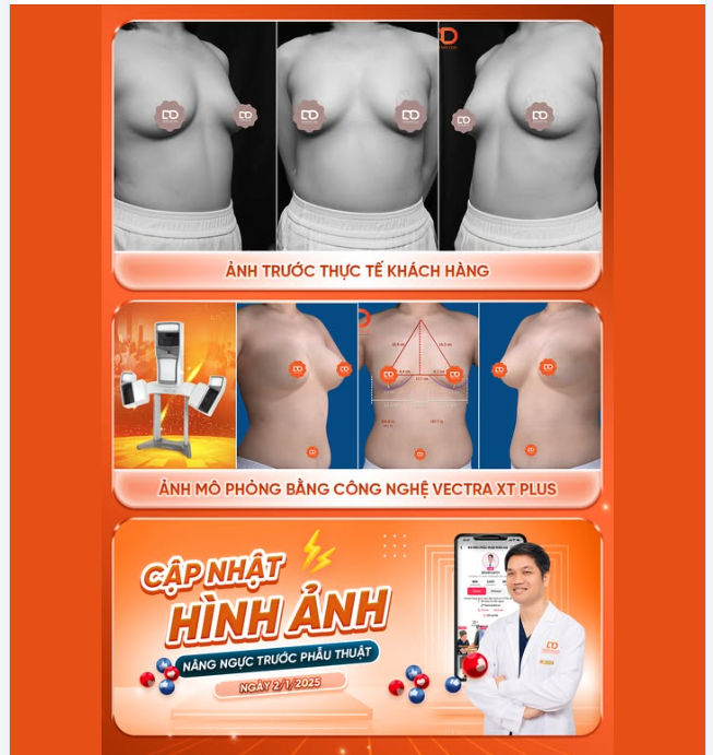PHẪU THUẬT ĐẶT TÚI ĐỘN CHO CHỊ KHÁCH HÀNG U40 ĐẾN TỪ THANH HÓA ...