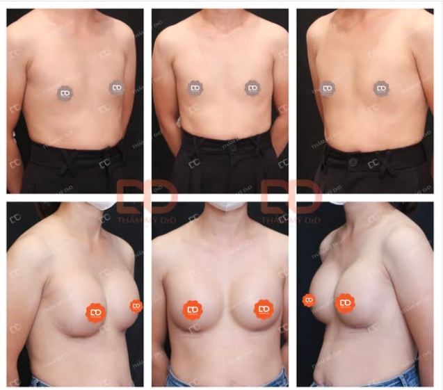 KẾT QUẢ NÂNG V1 SAU 1 THÁNG THỰC HIỆN TẠI DrD