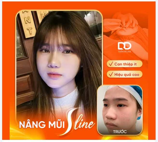 NÂNG MŨI SLINE DFORM - TẠO DÁNG MŨI ĐẸP "ĐỈNH NÓC KỊCH TRẦN"