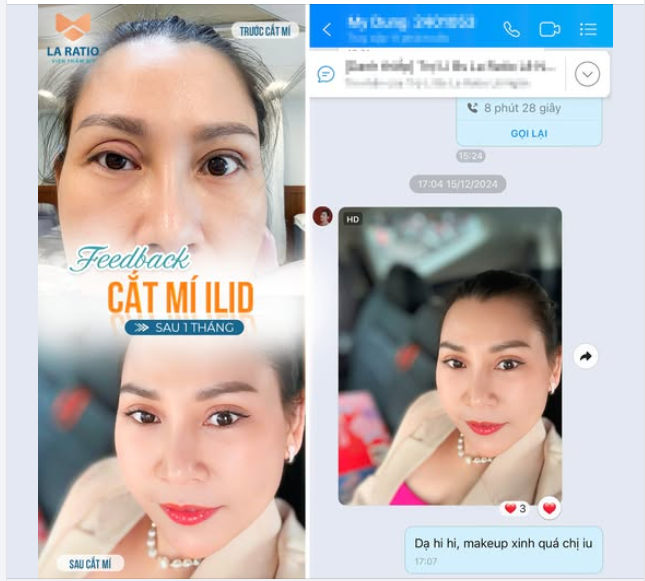 Chiếc feedback ​​​​​​​ điểm không có nhưng khi khách hàng cắt mí ILID tại nhà La Ratio sau 1 tháng cân chỉnh lại mí hỏng.